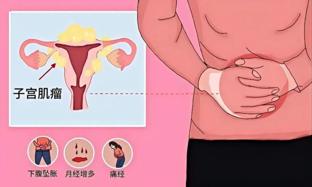 无创医疗时代 | HIFU治疗隔空打“瘤”，一次消融多颗肌瘤