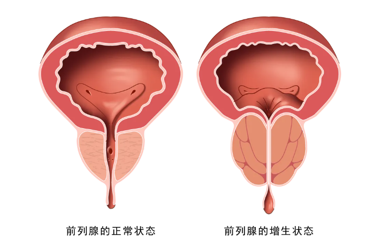 尿频、尿急、尿不尽，如何应对前列腺增生？