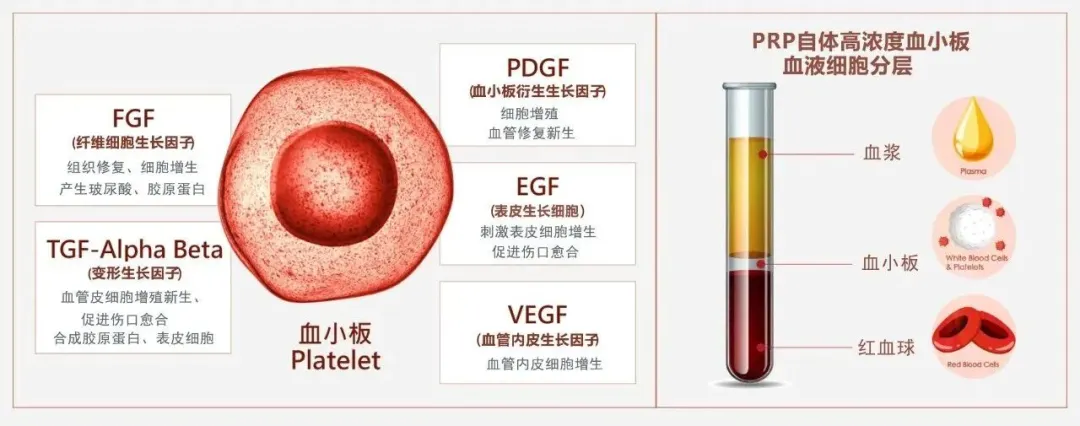 肌骨疼痛反复发作？PRP再生疗法，让受损组织“自我修复”