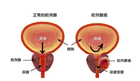 老龄化社会里，前列腺是被彻底忽视的老年男性隐痛